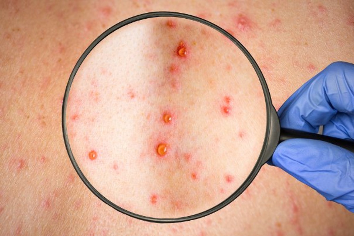 viruela-mono-oms-casos-confirmados