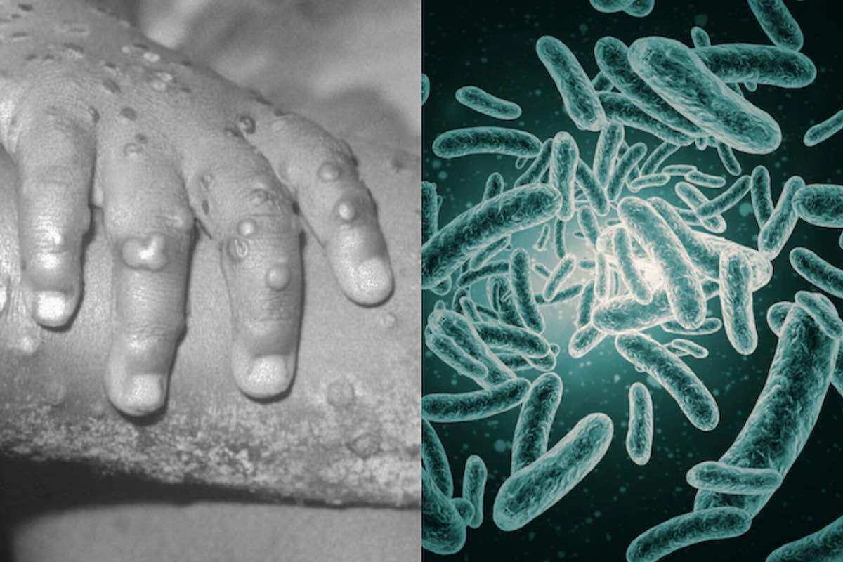 hidalgo-alerta-epidemiológica-caso-sospechoso-viruela-mono