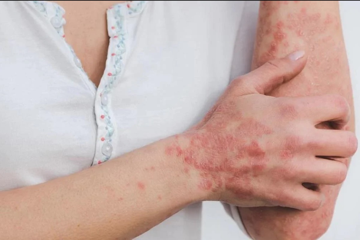 ssh-descarta-caso-viruela-mono-detecta-sospechoso