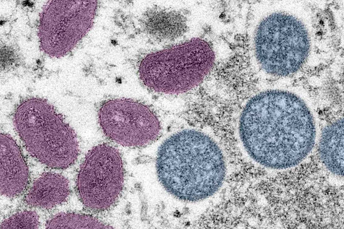 viruela-mono-contagios-america-aumento 1