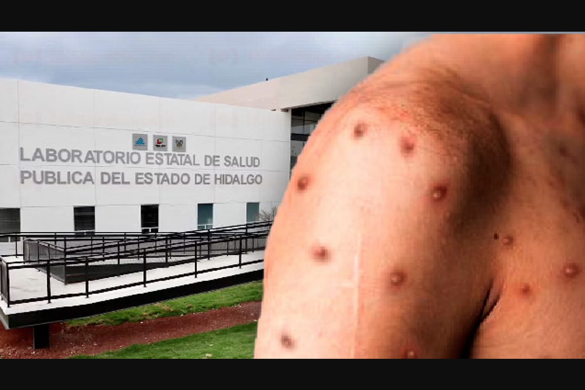 detectan-dos-casos-viruela-mono-hidalgo