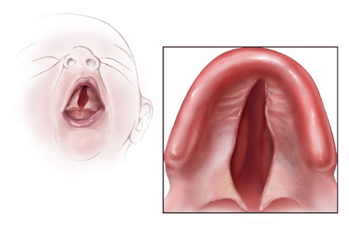 malformaciones-relacionadas-enfermedades-cronicas