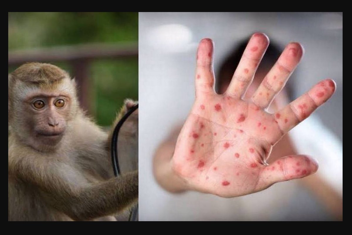 nuevos-casos-viruela-simica-hidalgo-indre