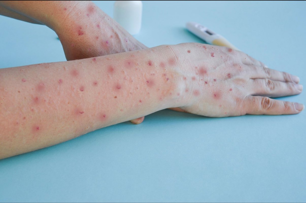 aumentan-14-casos-viruela-del-mono-hidalgo