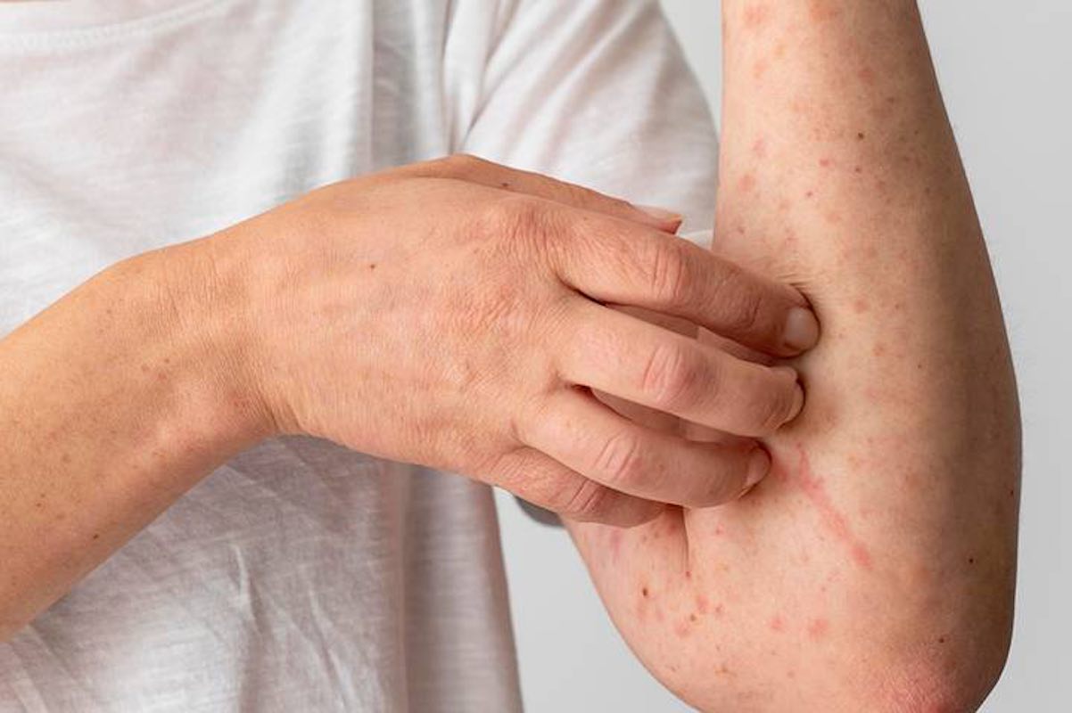 se-elevan-casos-incidencias-varicela-noviembre