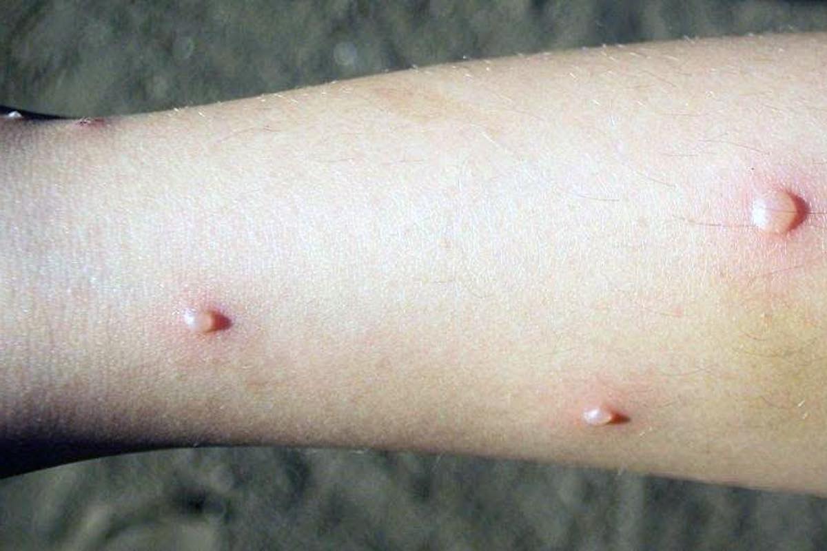 ya-son-casi-200-casos-coxsackie-hidalgo