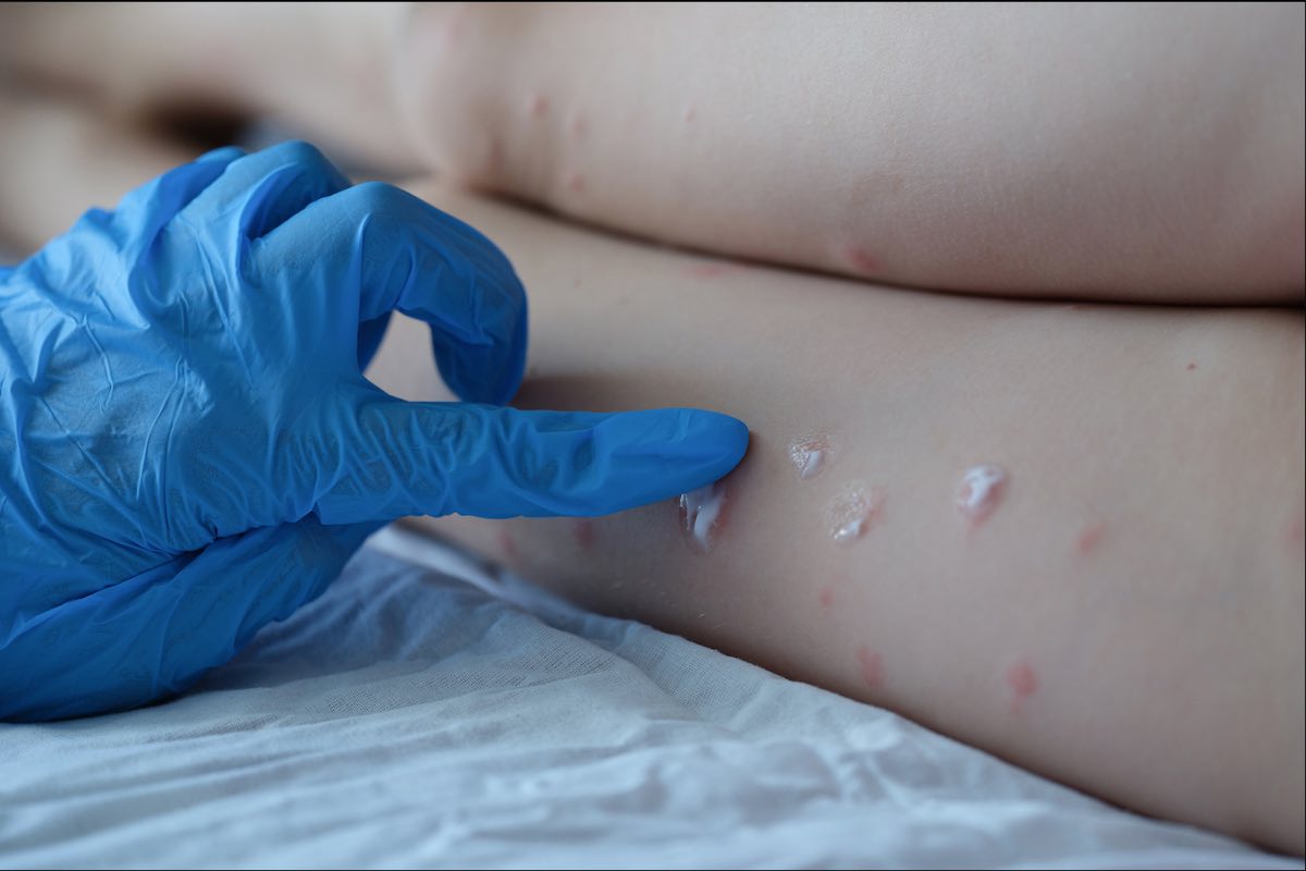 casos-viruela-del-mono-hidalgo