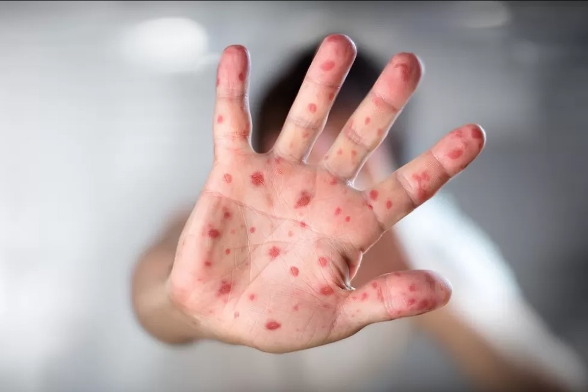 nuevos casos-viruela-mpox-mono-hidalgo